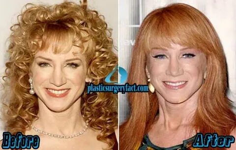 Kathy Griffin Plastic Surgery Before and After Pictures - Pl