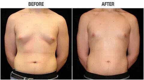 Gynecomastia surgery - Life Style and More