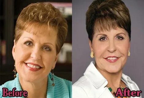 Joyce Meyer Plastic Surgery Before and After Top Piercings