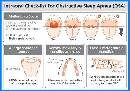 Sleep Apnea Raphaelson Sleep Center