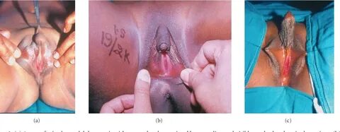 Figure 2 from Male Genitoplasty for Intersex Disorders Seman