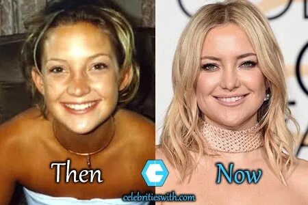 Download Kate Hudson Nose Job - Sonata Walls