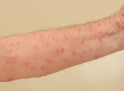 Effective Home Remedies Solution for Scabies - Drscabies