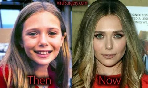 Elizabeth Olsen Plastic Surgery: Before and After Nose Job, 