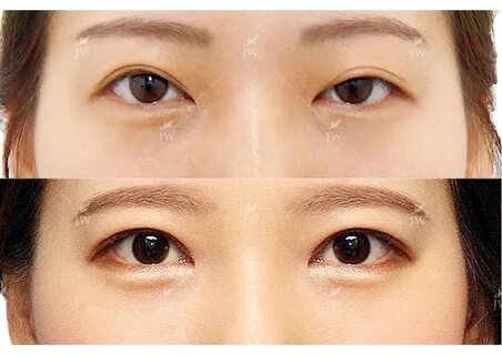 Ptosis Correction Double Eyelid Surgery in Korea - Центр Пла