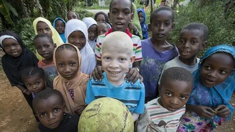 Discrimination Against Persons With Albinism; A Call For Str