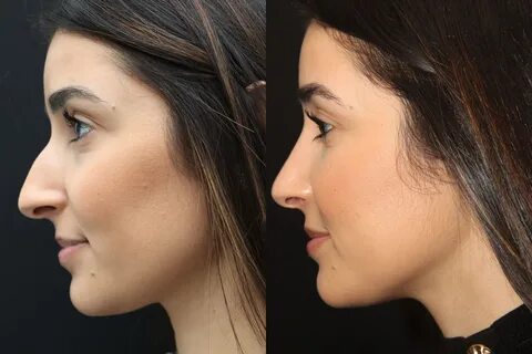 How To Get A Free Nose Job In Canada Reddit - sol-legas.org