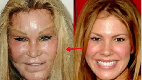 Worst Plastic Surgery Top 10 Worst Plastic Surgery Disasters