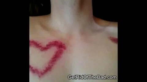 HOW TO - 5 tips to get rid of a HICKEY fast! - YouTube