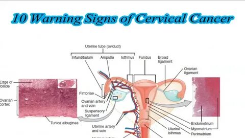 10 Warning Signs of Cervical Cancer - YouTube