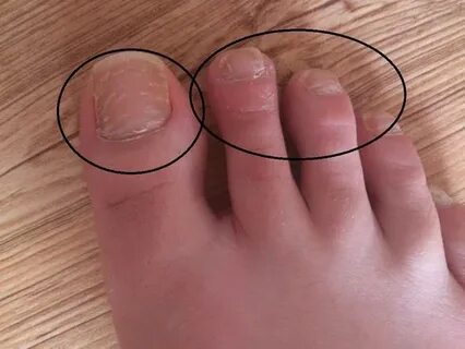 Veränderung der Fußnägel: Was kann das sein? (Füße, Nägel)