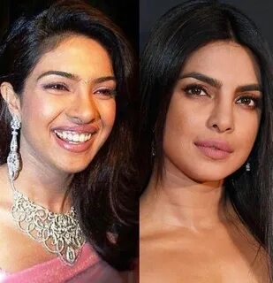 Priyanka Chopra.. Before and after plastic surgery!😳 #Herede