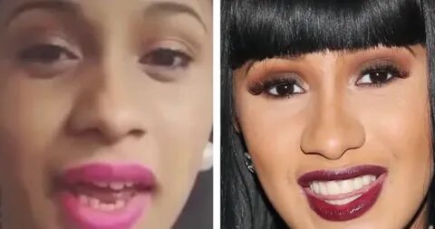 Cardi B Before and After Plastic Surgery Transformation