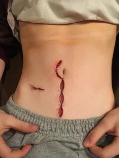 Ruptured Appendix Surgery - Imgur