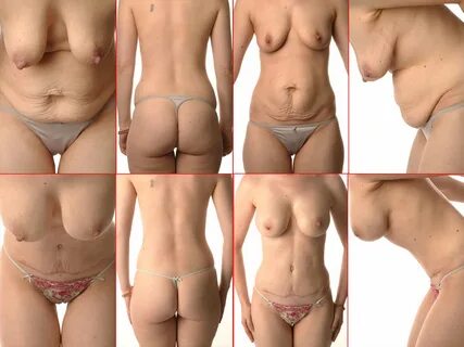 Before and After Montage 1, Breast Augmentation, Tummy Tuck,