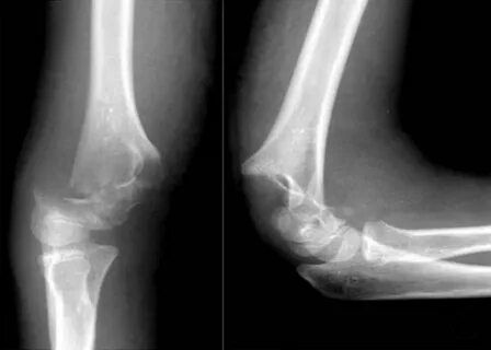 supracondylar fracture - Besko