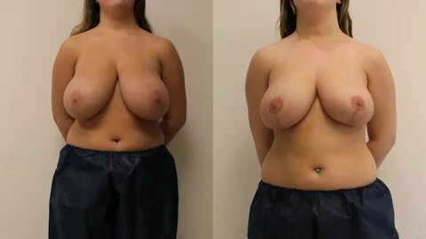 Go to Breast Reduction. 