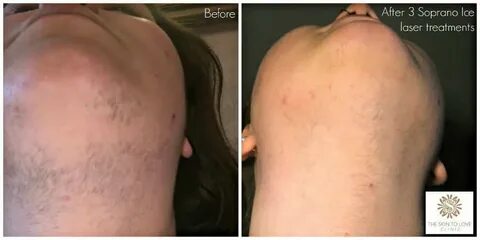 Laser Hair Removal Face Before And After