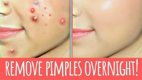 How To Remove Pimples Overnight Acne Treatment Shazia - YouT