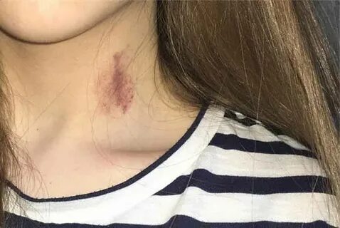 How Long Do Hickeys Last, Hickey Pictures, Definition, are t