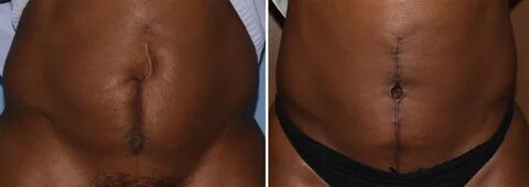 Plastic Surgery Case Study - The Vertical Tummy Tuck in a Mi