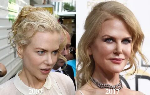 Nicole Kidman Plastic Surgery - Before and After Photos