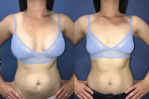 Lifting weights after breast augmentation Fucking Pics Other