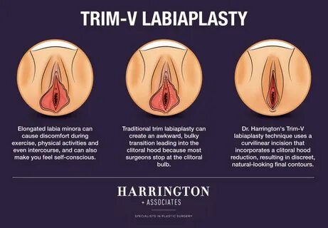 Labiaplasty Swelling