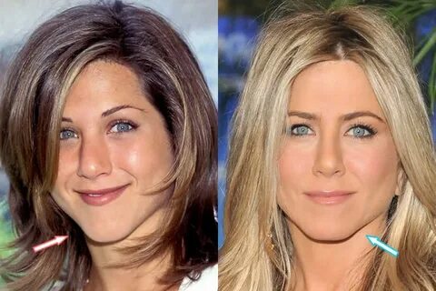 Has Jennifer Aniston Had Plastic Surgery? (Before & After 20