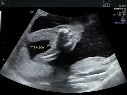18 Week Ultrasound - December 2018 Babies Forums What to Exp