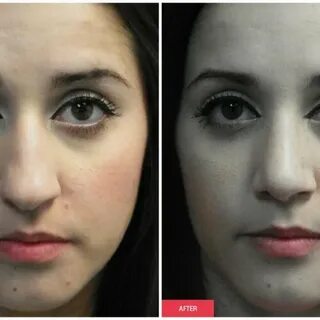 Before & After Nose Surgery Gallery Dr. Anthony Bittar