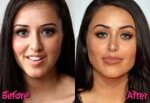 Marnie Simpson Nose Job: A Job Done Right