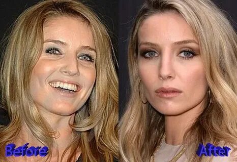 Annabelle-Wallis-Before-and-After-Rhinoplasty-Surgery - Cele