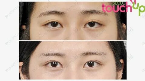 How double eyelid surgery has become a rite of passage for m