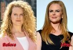 Nicole Kidman Before and After Cosmetic Surgery Celebrity pl