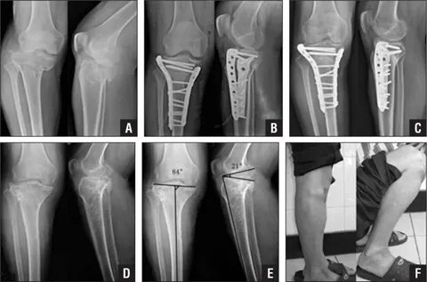 Treatment of Complicated Tibial Plateau Fractures With Dual 