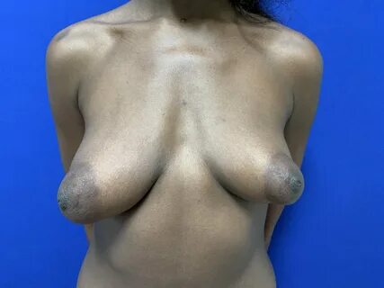 Ugly boobs tubular nude