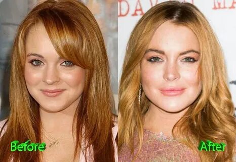 Lindsay Lohan Plastic Surgery: An Improvement?