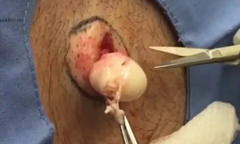 Video shows Dr Pimple Popper pulls an EYEBALL-like cyst out 