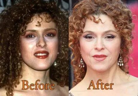 Bernadette Peters Plastic Surgery: FACELIFT, BOTOX