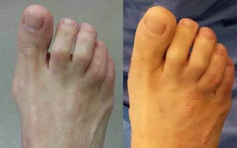 Bunion Pain Options