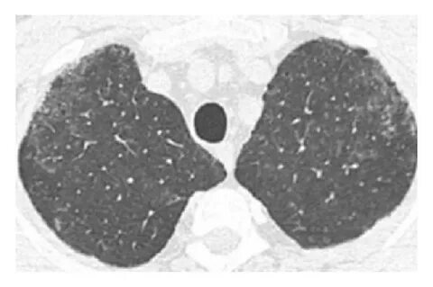 Respiratory bronchiolitis-associated interstitial lung disea