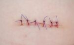 In surgery, the stitch seems to still have a bright future a