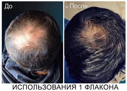 FEG Hair Regrowth Spray, Для роста волос,средство для роста 