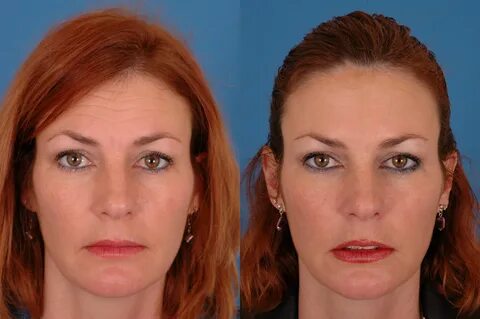 Botox Before & After Photos Benjamin Bassichis MD, FACS