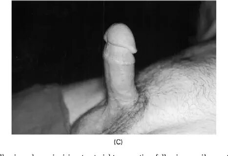 Figure 1 from Management of Peyronie's disease with penile p