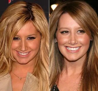 Celebrity Nose Jobs - Before and After Pictures