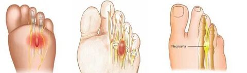 Visiting Podiatrists Treat Neuromas in Chicago Podiatrists H