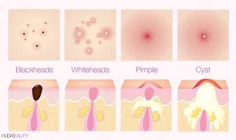 How To FINALLY Decode Your Acne & Find The Best Treatment Fo