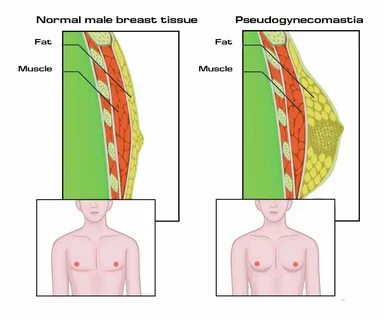 Difference between man boobs and gynecomastia